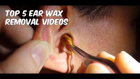 Watch her use the ear irrigation technique to help this near. . Youtube videos ear wax removal